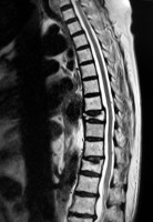 Feature Review: Vertebroplasty for treating spinal fractures due to osteoporosis