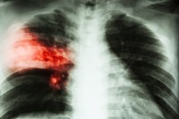 Cochrane Library release updated Special Collection on diagnosing tuberculosis