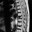 Feature Review: Vertebroplasty for treating spinal fractures due to osteoporosis