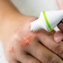 The findings of this research may challenge the prescribing of H1 antihistamines for patients with eczema.