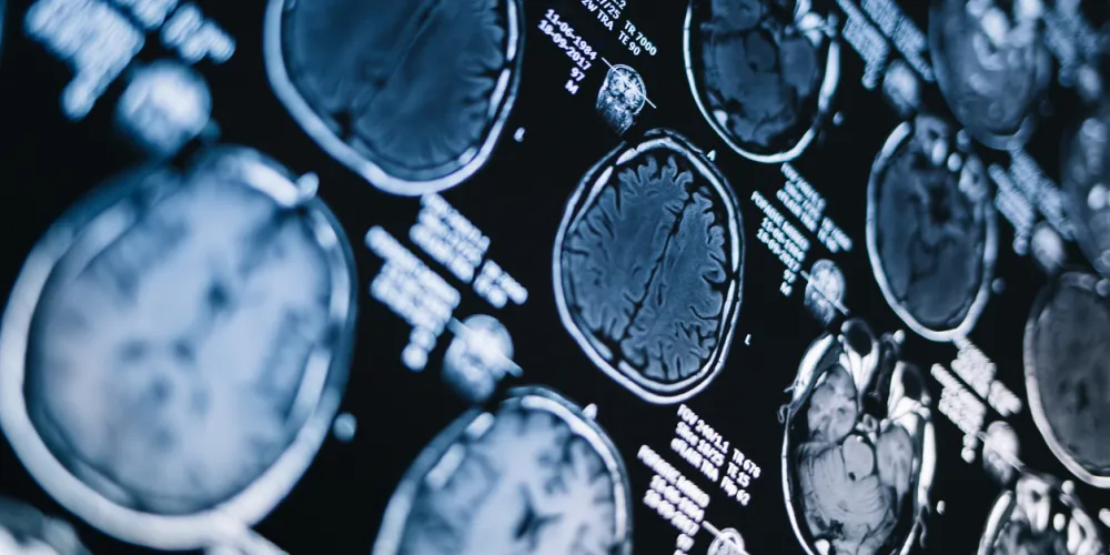 Close-up of several brain MRI scans displayed in a grid pattern. The images show different cross-sectional views using shades of gray on a black background.